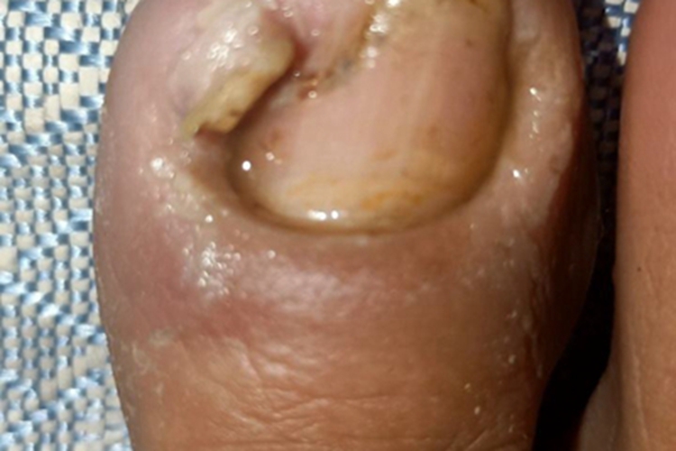 慢性甲沟炎化脓图