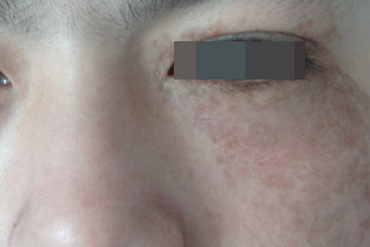 太田痣眼周有暗红色斑图