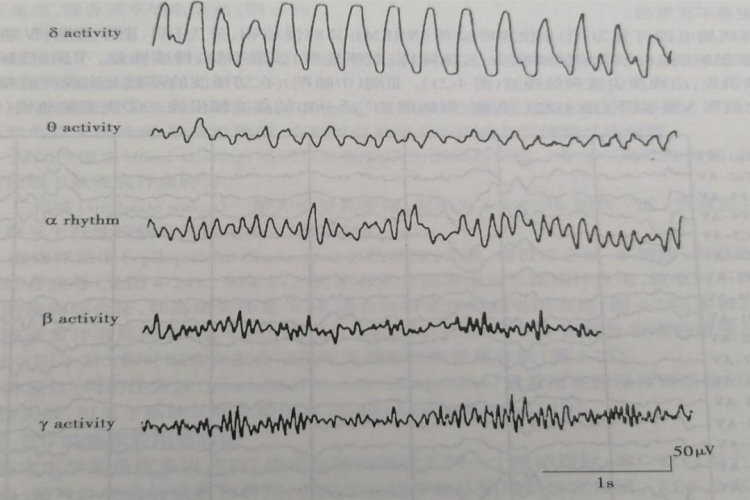 小儿的正常脑电图波形图