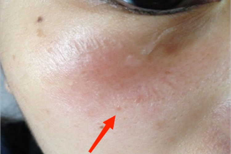 继发性斑状萎缩发红图 继发性斑状萎缩发红图