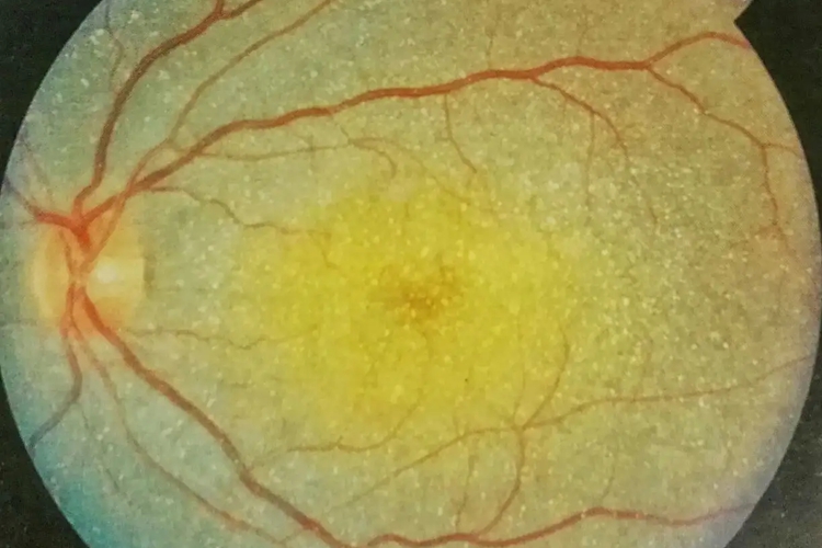 视网膜色素变性眼底图