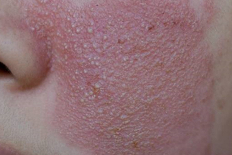 慢性接触性皮炎面部丘疹图 慢性接触性皮炎面部丘疹图