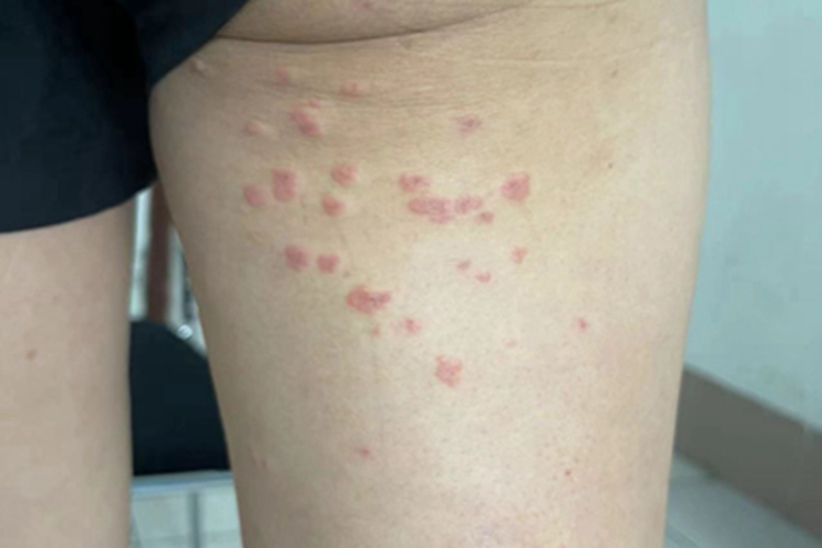 离心性环状红斑大腿症状图