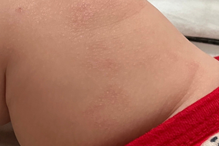 婴儿脂溢性皮炎大腿红斑图
