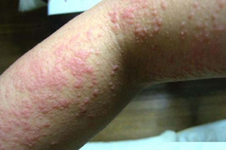 变应性接触性皮炎丘疹图