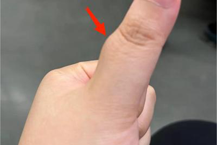 腱鞘纤维瘤手指肿块图 腱鞘纤维瘤手指肿块图