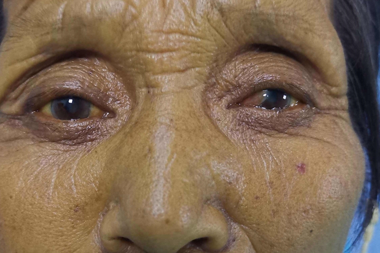 皮肤巩膜黄染图 皮肤巩膜黄染图