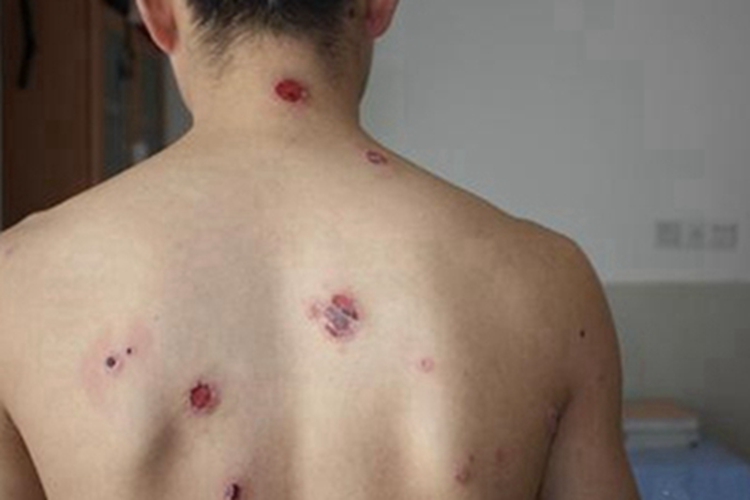 结节性梅毒疹背部症状图