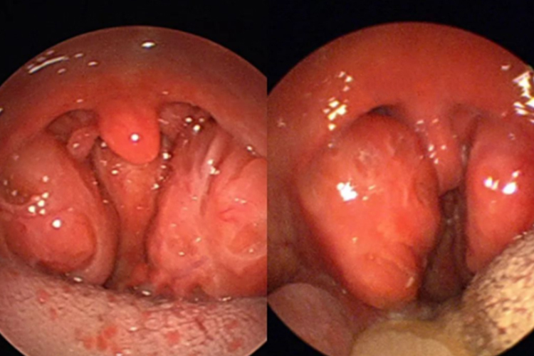 扁桃区域肿物图 扁桃区域肿物图