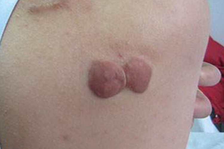 瘢痕疙瘩性芽生菌病肩部结节图 瘢痕疙瘩性芽生菌病肩部结节图