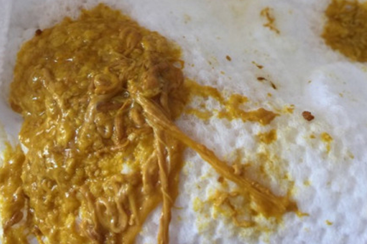 婴儿大便有长条丝状物