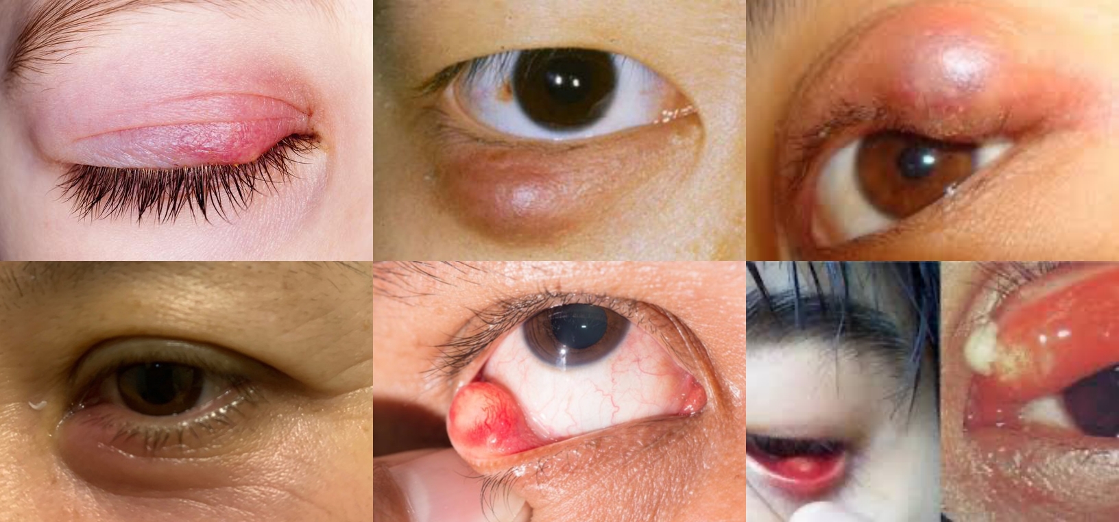 过敏性眼睑炎怎么治疗图片