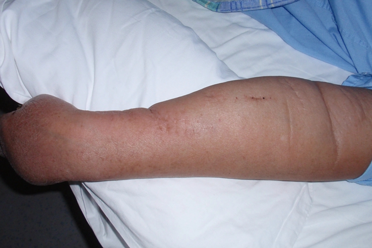 血栓性浅静脉炎手臂肿胀图