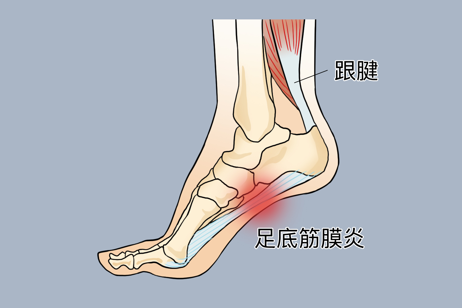 足底筋膜炎解剖图图片