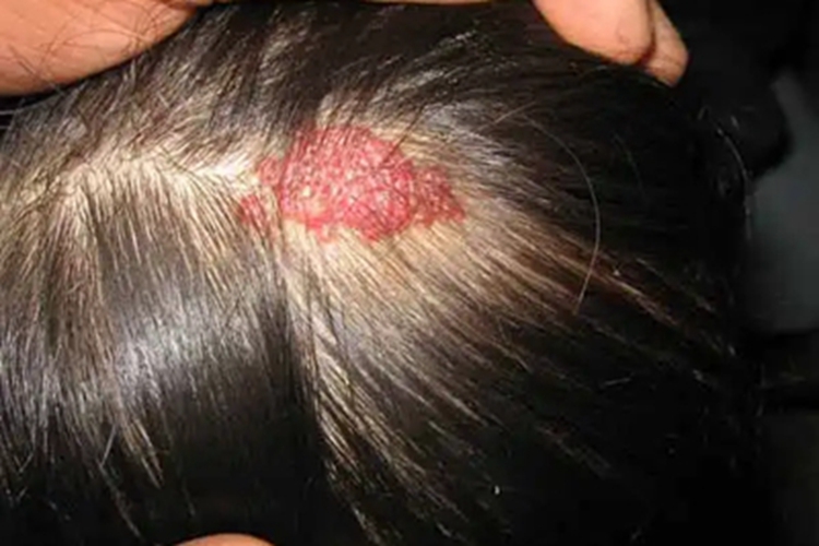 蔓状血管瘤初期图