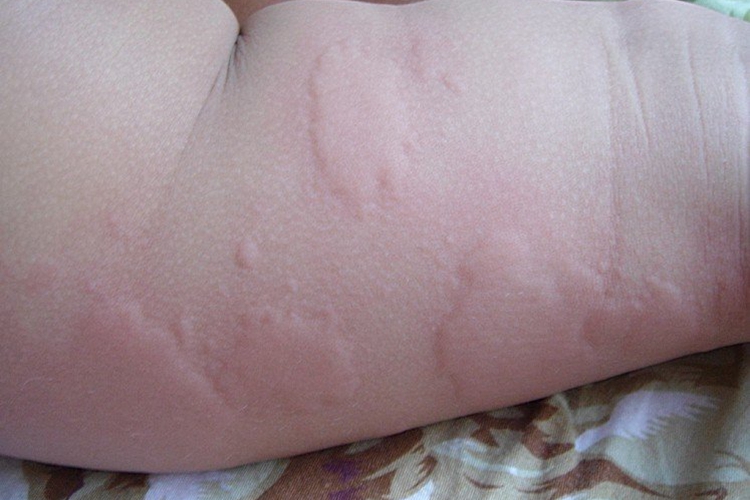 孩子过敏皮肤风团图