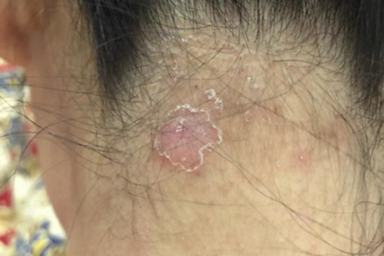 脂溢性皮炎后颈症状图 脂溢性皮炎后颈症状图