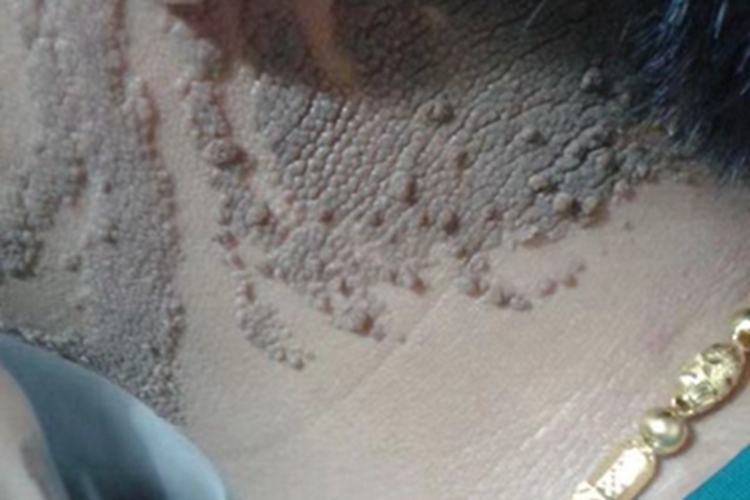 泛发型表皮痣侧颈症状图