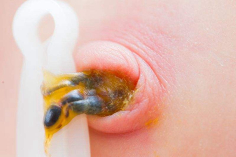 脐窝湿疹肚脐发黄渗液图