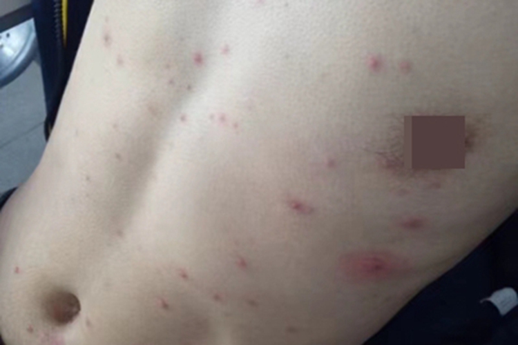 水痘肚子上有丘疹和红斑图