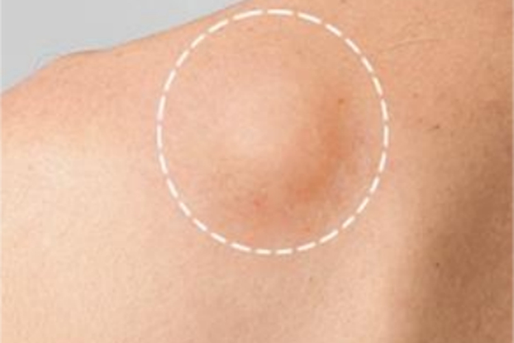 血管脂肪瘤疙瘩图 血管脂肪瘤疙瘩图