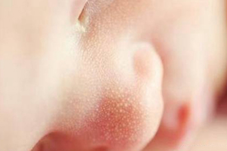 皮脂腺增生症状图