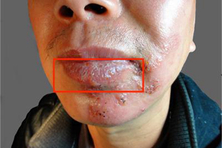 口腔疱疹嘴唇小水疱图