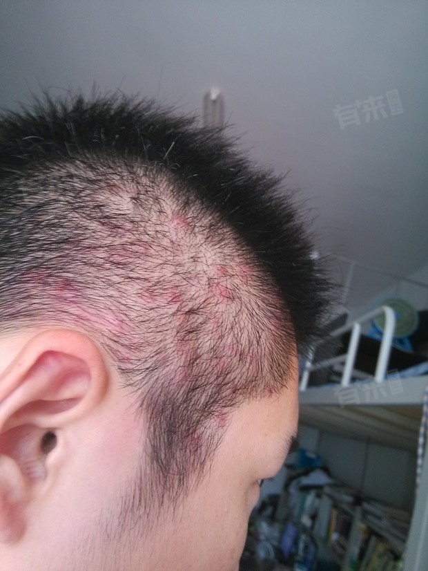 头上长红疙瘩毛囊炎怎么治疗