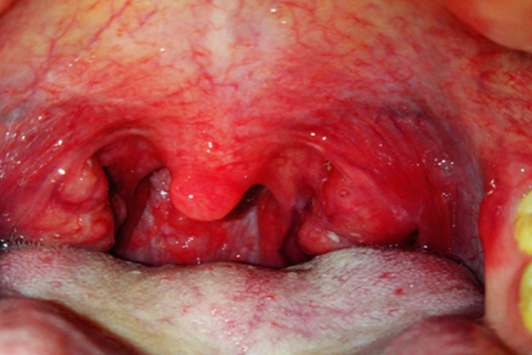 扁桃体炎咽喉发红图 扁桃体炎咽喉发红图
