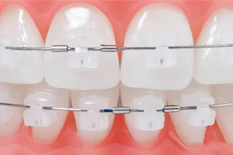 陶瓷自锁托槽图