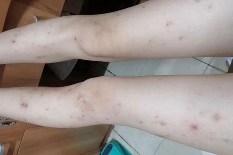 炎症后色素沉着图