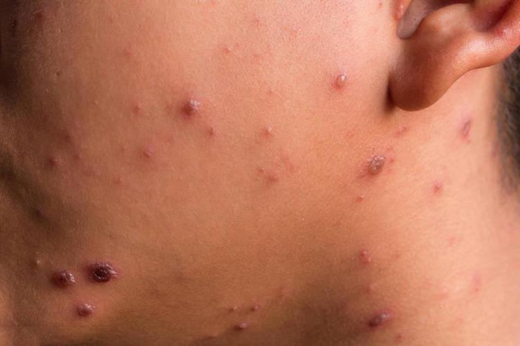 脖子脓疱样梅毒疹