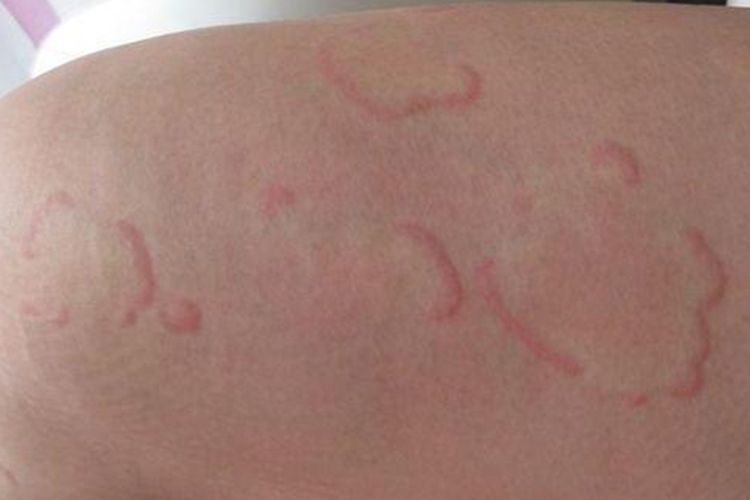 远心性环状红斑图