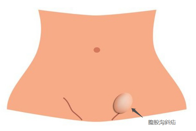 女性腹股沟斜疝图 女性腹股沟斜疝图