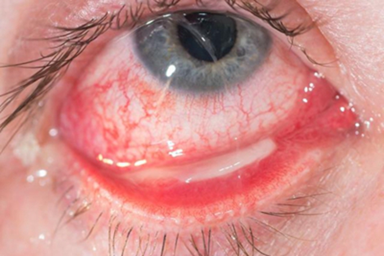 细菌性结膜炎眼部症状图