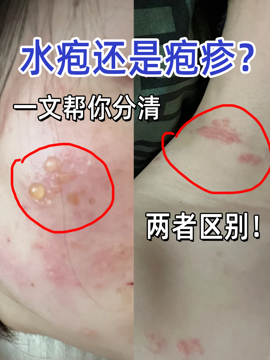 水疱还是疱疹?一文帮你分清两者区别!