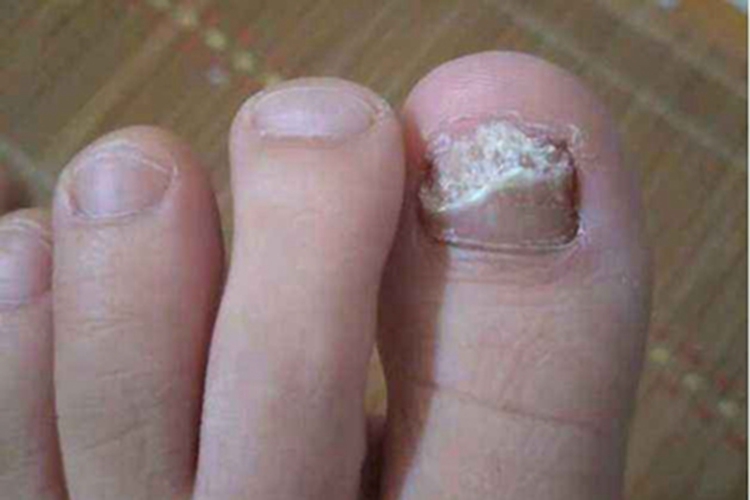 后天性脚趾甲增厚症状图