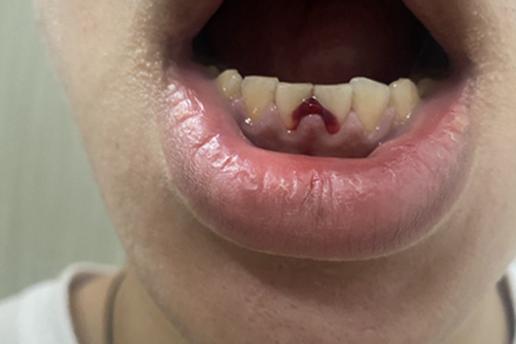 牙龈炎牙龈肿胀出血图 牙龈炎牙龈肿胀出血图