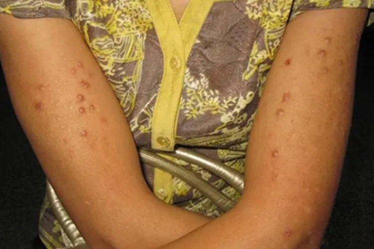 单纯性痒疹胳膊症状图 单纯性痒疹胳膊症状图