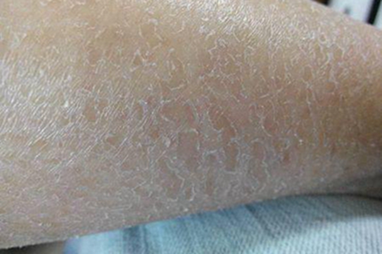 无汗症皮肤粗糙图 无汗症皮肤粗糙图