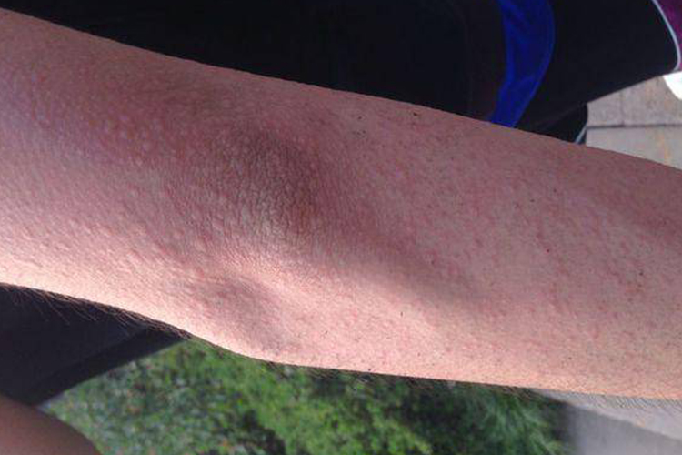 胆碱能性荨麻疹图