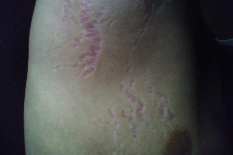 腋下萎缩纹皮肤裂开发红图