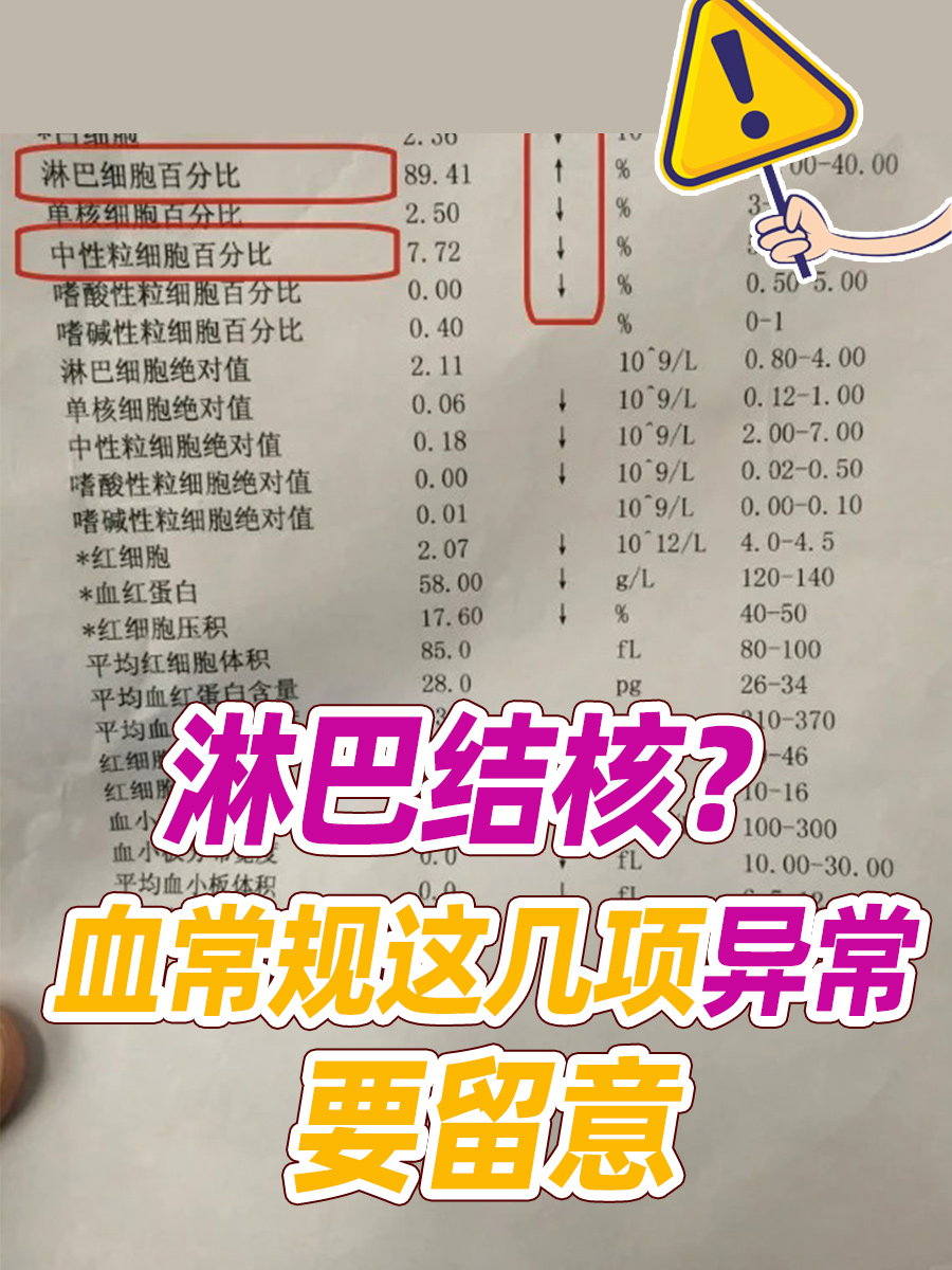 淋巴结核?血常规这几项异常要留意