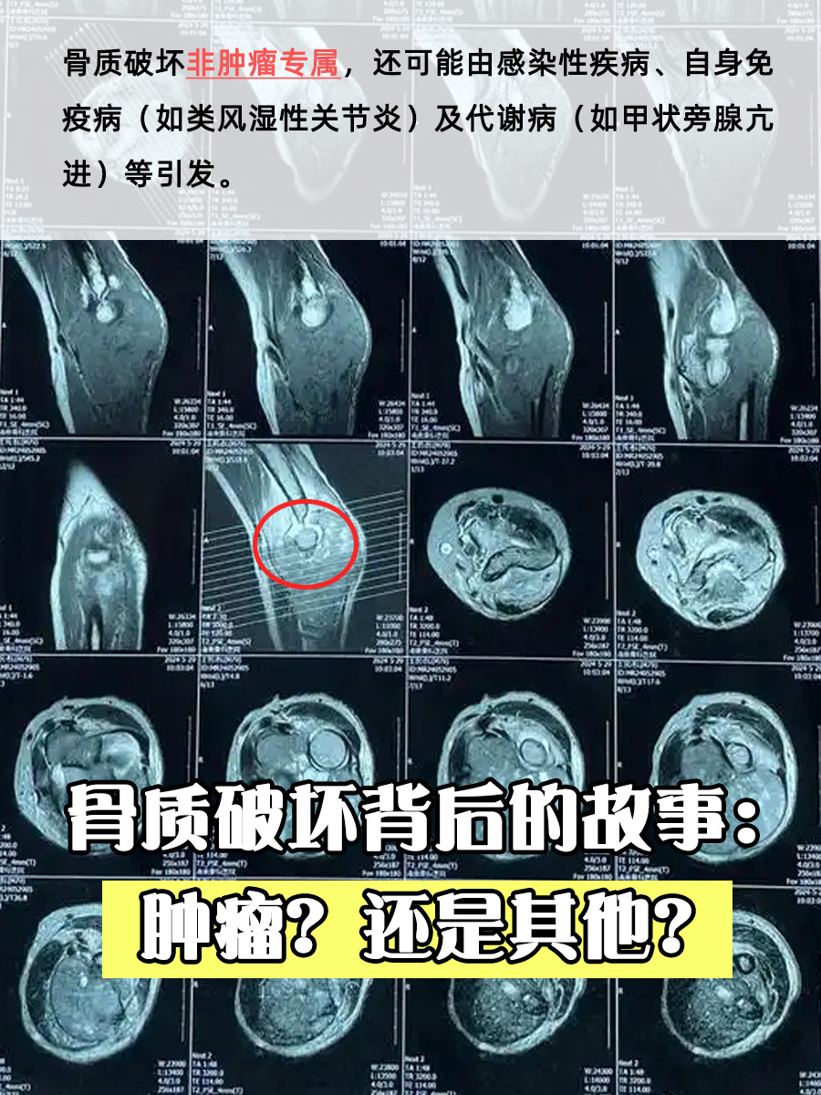 骨质破坏背后的故事：肿瘤？还是其他？