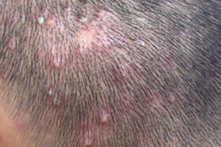 毛囊性脓疱病脓包图