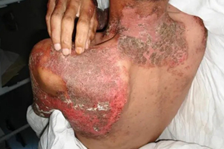 糙皮病背部焦痂图