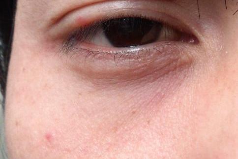 混合性皮肤偏干型图 混合性皮肤偏干型图