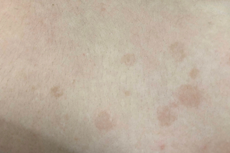 花斑癣背部斑片图