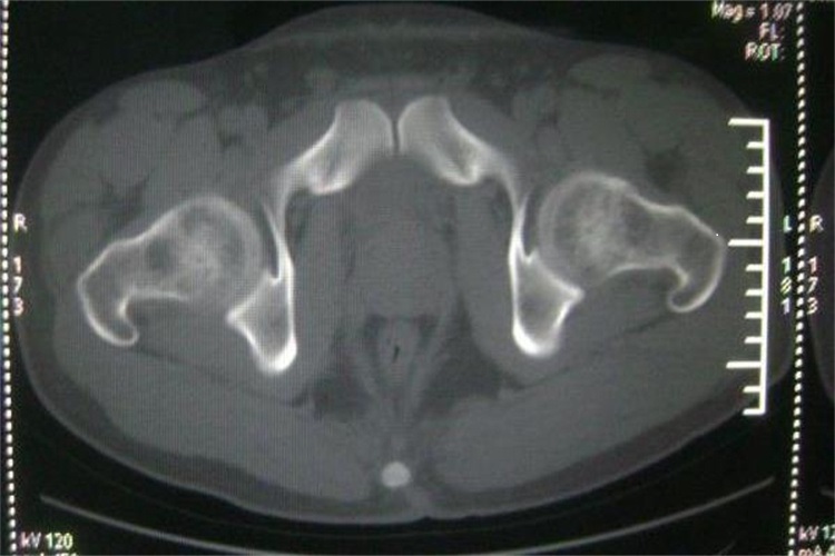 正常的髋关节CT图