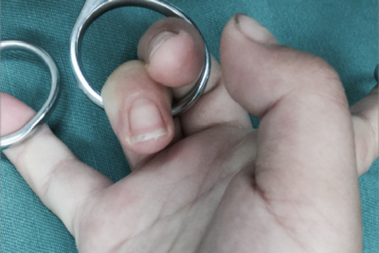 缺血性肌挛缩僵硬图 缺血性肌挛缩僵硬图